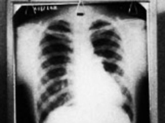 Thumbnail image for Tuberculosis and the Māori People of the Wairoa District