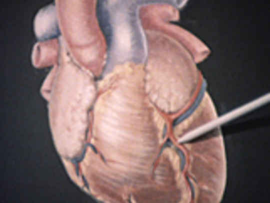 Thumbnail image for Recovering from a Coronary